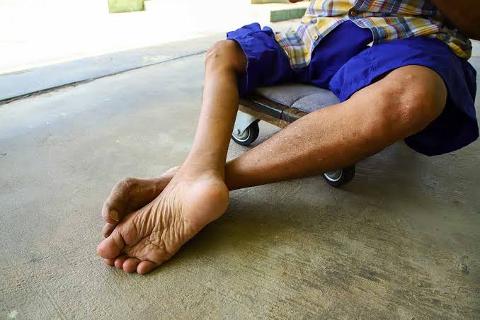 Kepala Dinas Kesehatan (Dinkes) Kabupaten Kutai Timur (Kutim), dr Bahrani Hasanal jelaskan apa itu penyakit polio yang biasanya menyerang anak-anak.