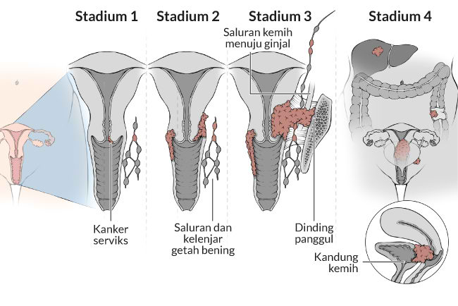 Kanker serviks umumnya berkembang perlahan dan baru akan menunjukkan gejala ketika sudah memasuki stadium lanjut.